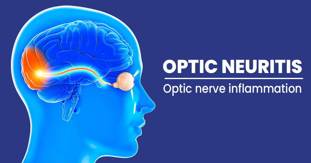Optic Neuritis- Threat to vision loss